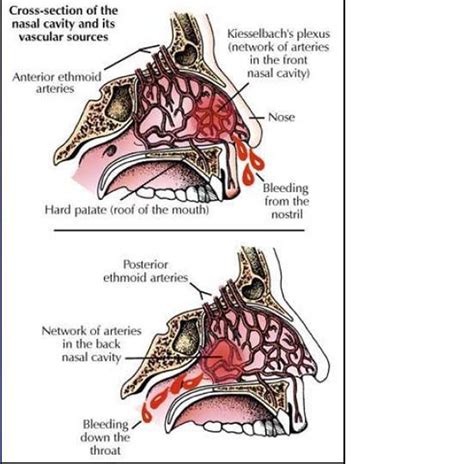 sangerarea nazala|Sângerare nazală (epistaxis)